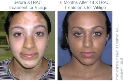Xtrac before and after