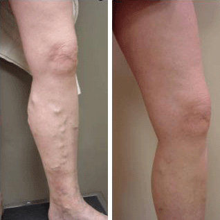 FAQs about Endovenous Ablation Treatment for Varicose Veins