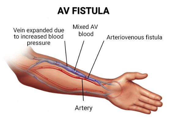 AV Fistula