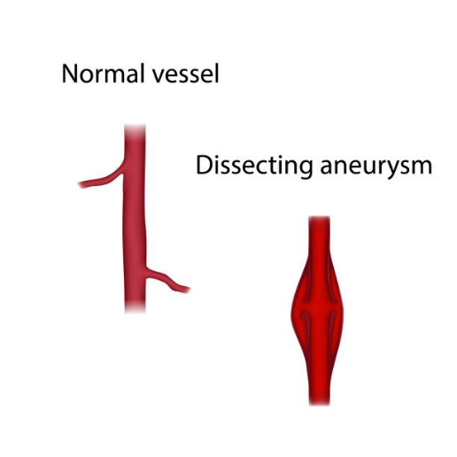 Aortic Dissection