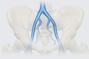 Chronic Venous Disease