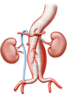 Endovascular Repair