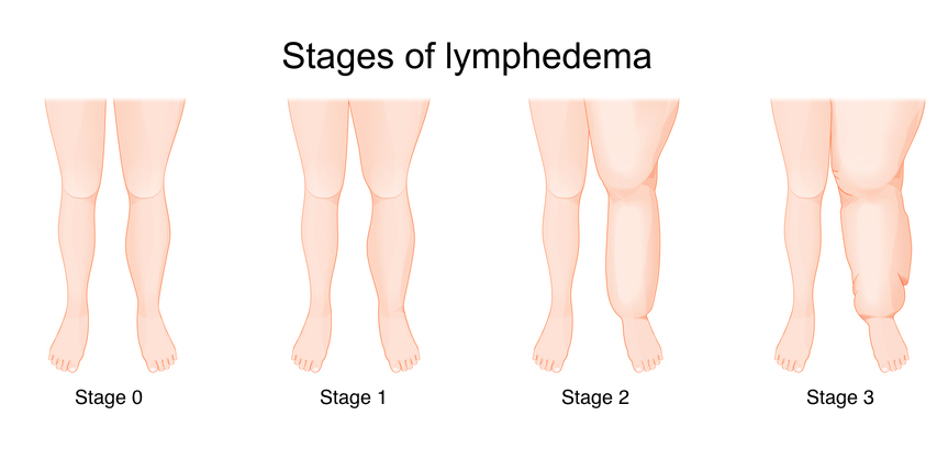 Lymphedema