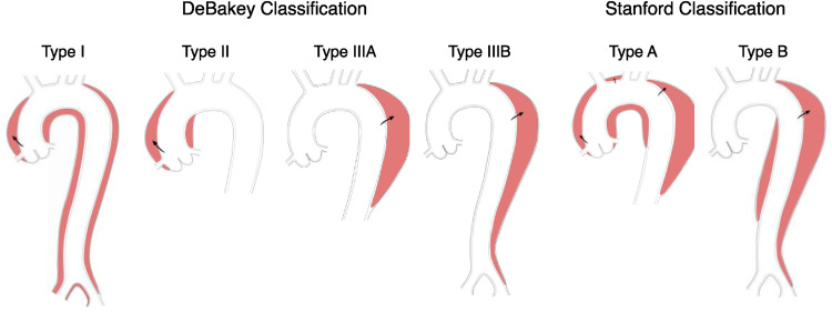 Aortic Dissection